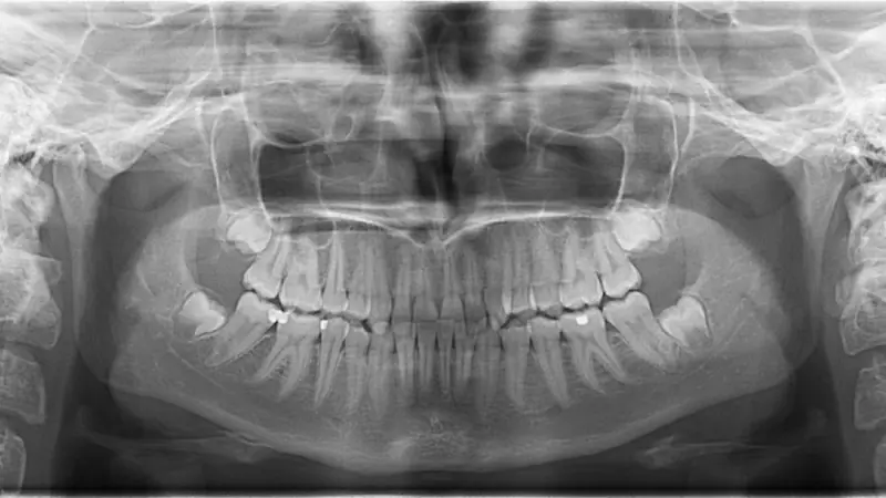 Wisdom Teeth Removal Recovery article from Emergency Dentist of Fort Lauderdale