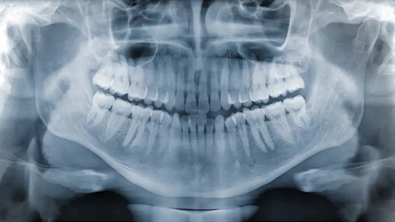 Emergency Root Canal treatment at Emergency Dentist of Fort Lauderdale